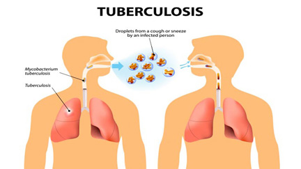 STREAM study gives hope for better treatment of drug-resistant TB