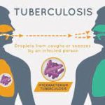 Despite strong efforts to control TB, 1.1 million people died of TB in 2023